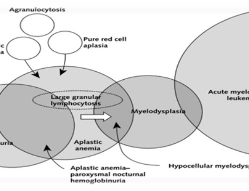 Diagnosis, Pathophysiology and Management of Aplastic Anemia